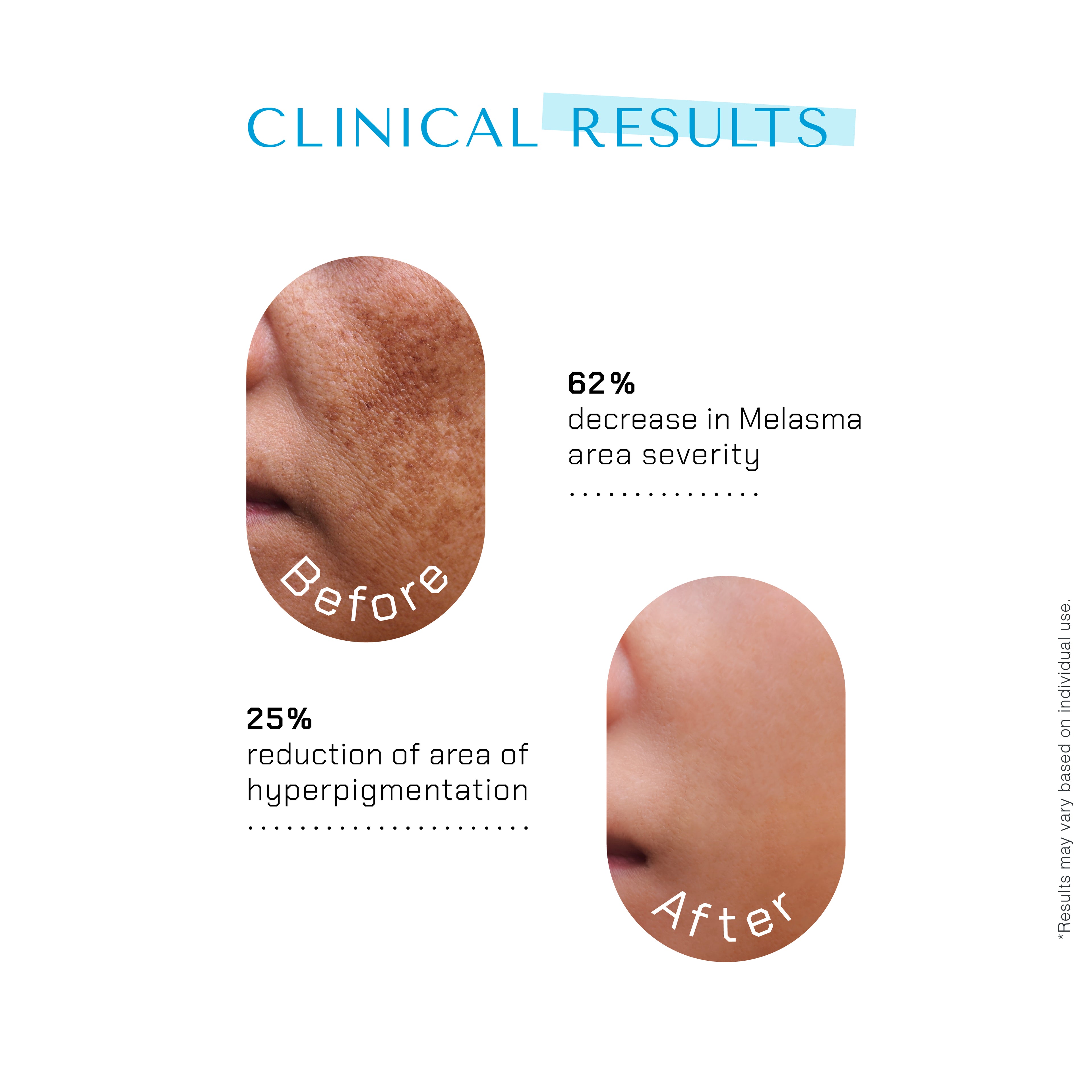 The Remedist by Dr Rhazes Niacinamide PC &amp; Zinc Face Serum (30ml) key ingredients before after