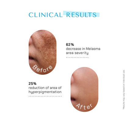 The Remedist by Dr Rhazes Niacinamide PC &amp; Zinc Face Serum (30ml) key ingredients before after