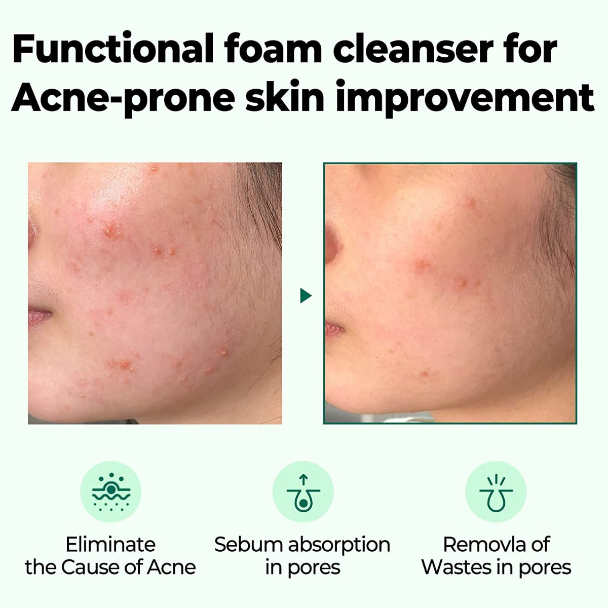 SOME BY MI AHA BHA PHA 30 Days Miracle Acne Clear Foam (100ml)