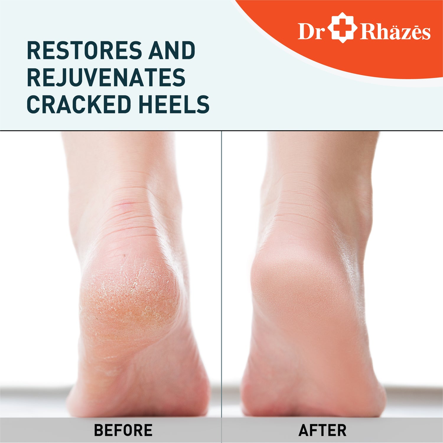 Dr Rhazes Foot Cream - Heals Cracked Heels (50g)